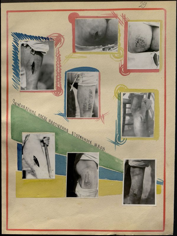 Original image: Healing after applying secondary sutures