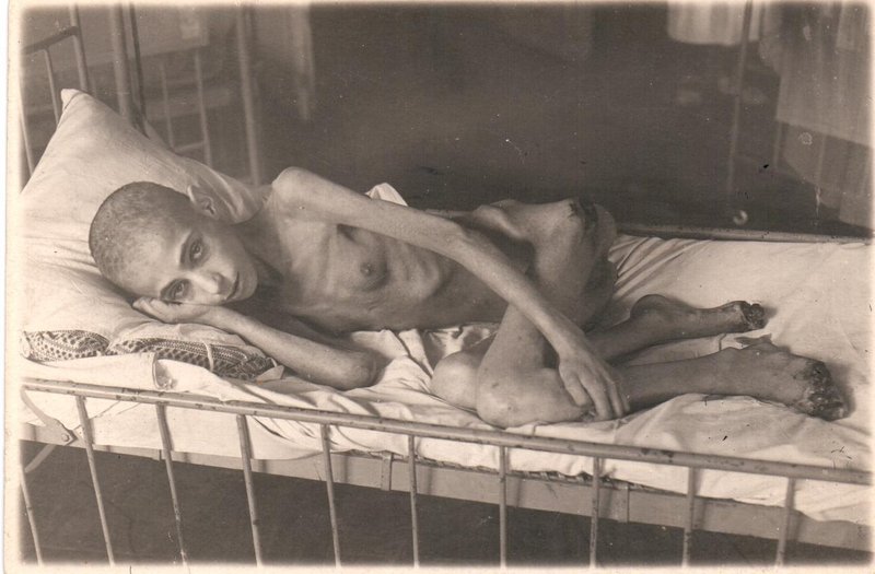 Дети блокадного Ленинграда, страдающие дистрофией. 1941-1944 гг. Скобио Белла, 13 лет, дистрофия III степени