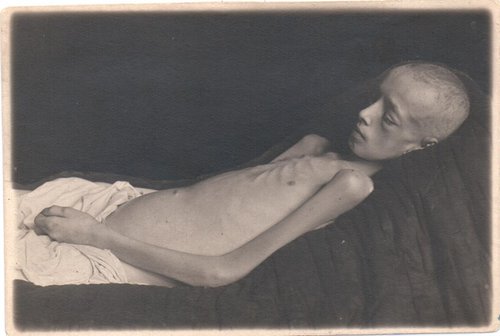 Дети блокадного Ленинграда, страдающие дистрофией. 1941-1944 гг. Павлов. Дистрофия III ст. Умер
