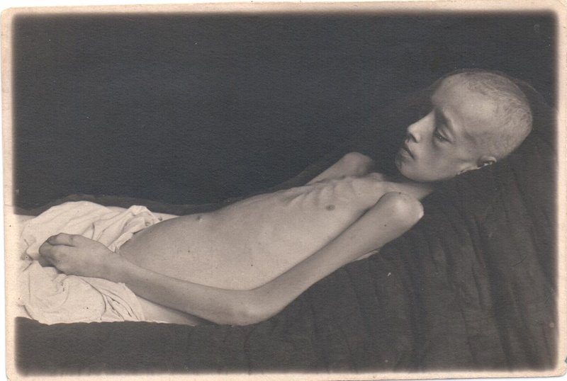 Дети блокадного Ленинграда, страдающие дистрофией. 1941-1944 гг. Павлов. Дистрофия III ст. Умер