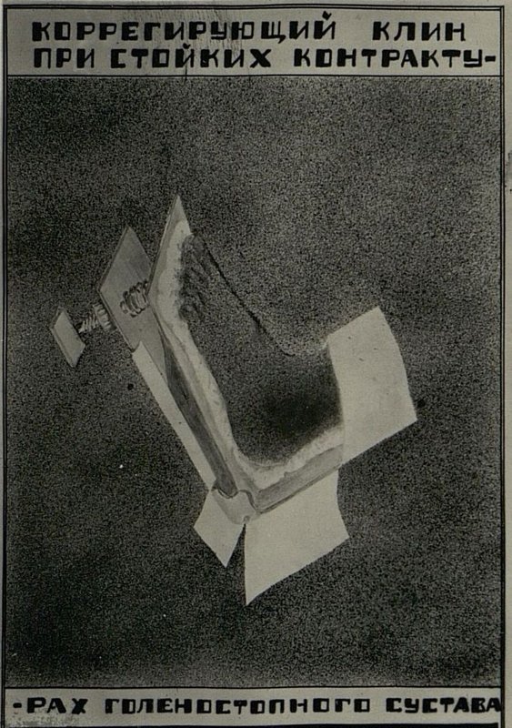 Image: Corrective wedge for persistent contractures of the ankle joint