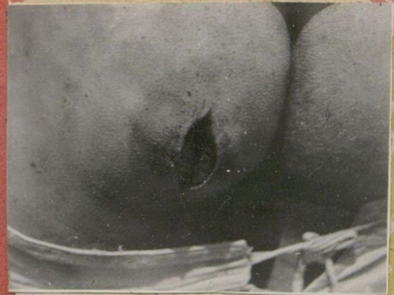 Фотография: Заживление после наложения вторичных швов