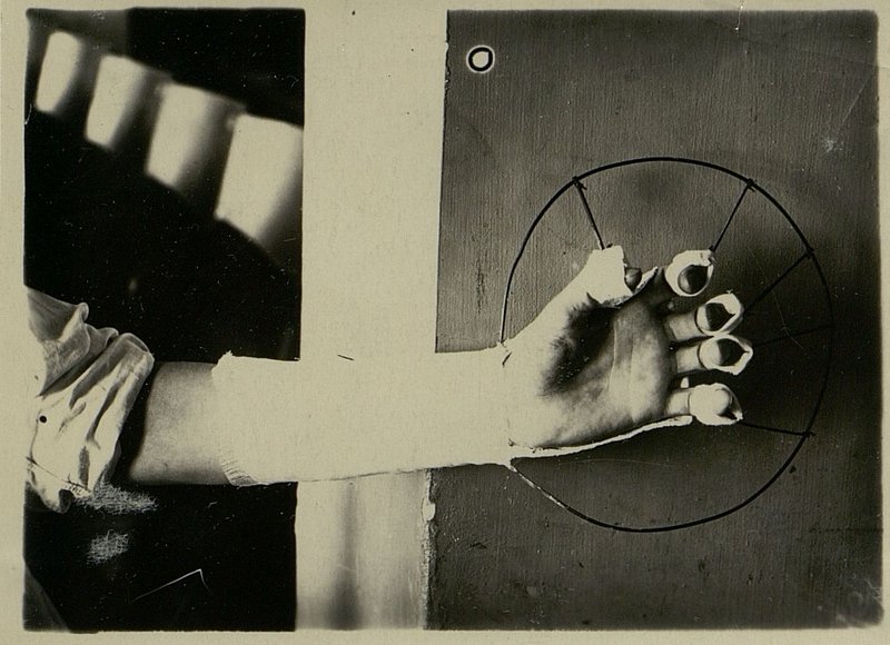 Image: Functional treatment for finger injuries