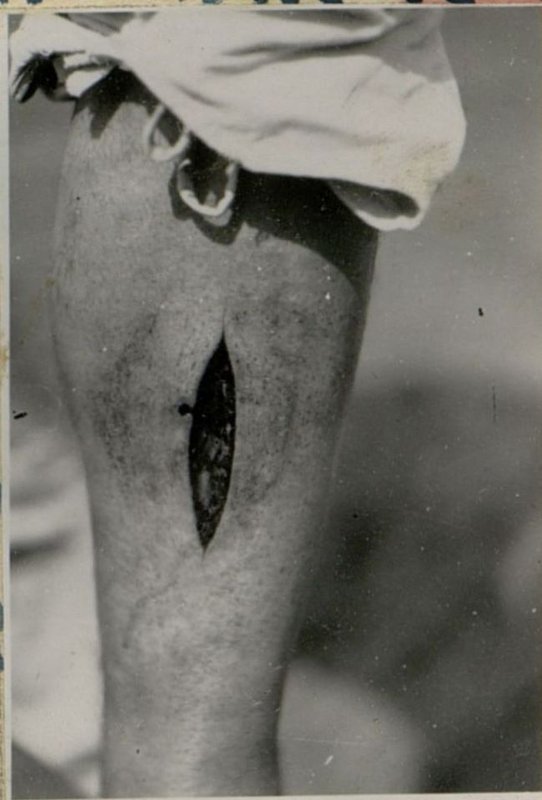 Image: Healing after applying secondary sutures